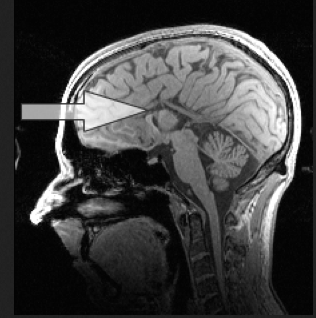Complete Agenesis of the Corpus Callosum
