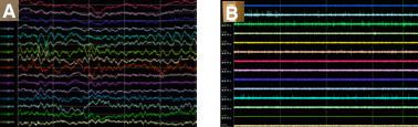 Intracranial Recordings graphic