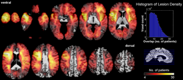 lesion overlaps