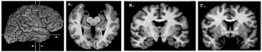MRI scans of brain