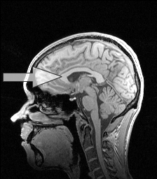 An MRI of a normal brain. The arrow points to the corpus callosum.