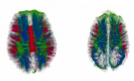 corpus callosum