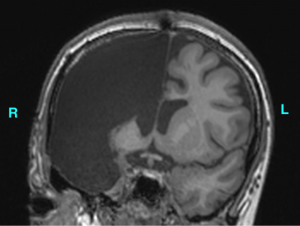 Brain with surgically removed right hemisphere