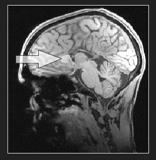 Partial AgCC