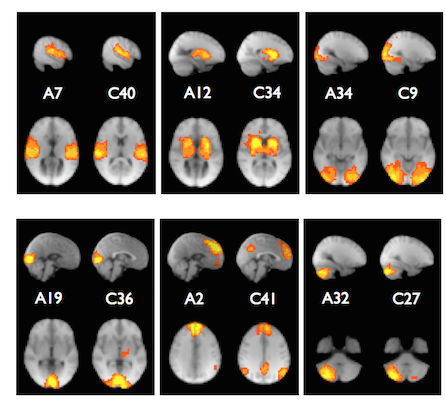 Brains with DCC