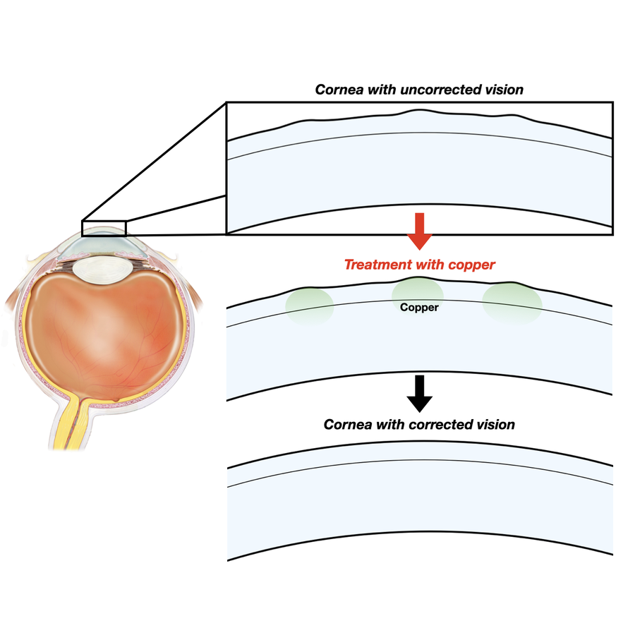 Three step photo that shows a cornea with uncorrected vision, treatment with copper and then a figure that shows the cornea with corrected vision.