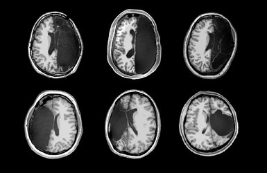 Structural images from a Caltech investigation of six of rare hemispherectomy patients, all of whom received the surgeries as children and now have relatively normal cognitive abilities.