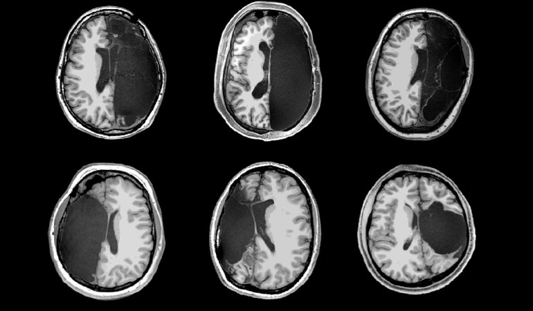 Structural images from a Caltech investigation of six of rare hemispherectomy patients, all of whom received the surgeries as children and now have relatively normal cognitive abilities.