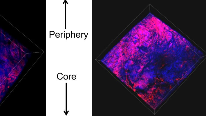 A tumor stained with pink biomarkers labeling gene regulation.