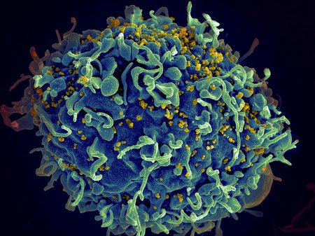 HIV (yellow) infecting a human cell