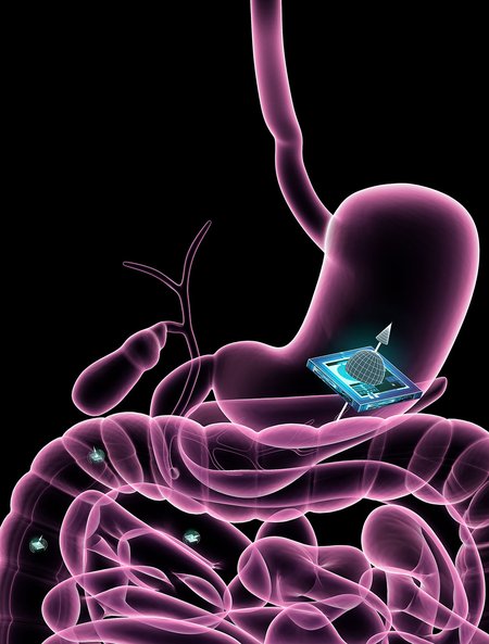illustration of chip in gut