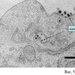 An electron micrograph showing the presence of numerous siRNA-containing targeted nanoparticles both entering and within a tumor cell