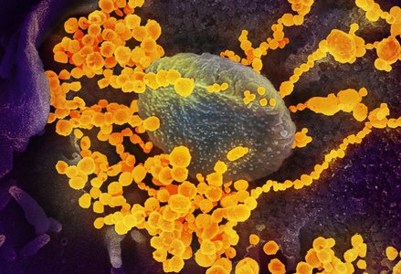 scanning electron microscope image of SARS-CoV-2 emerging from the surface of cells cultured in the lab