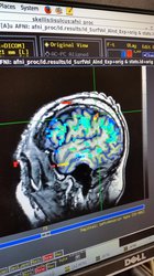 brain scan
